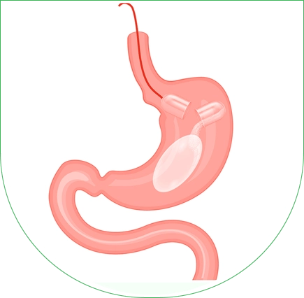 : une solution non chirurgicale pour perdre du poids Accueil » Ballon gastrique en Tunisie : une solution non chirurgicale pour perdre du poids 