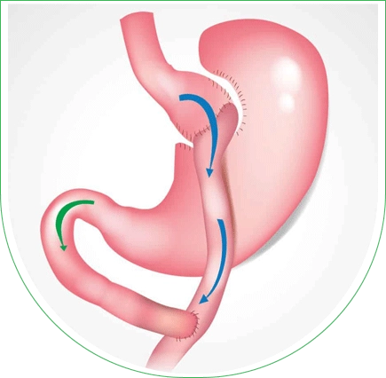 Bypass gastrique en Tunisie