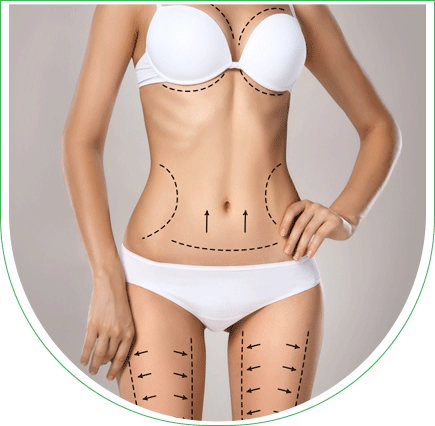 Liposuccion complète