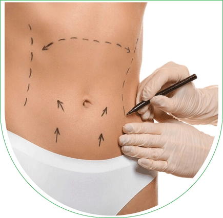 Liposuccion Haute Définition (HD) en Tunisie