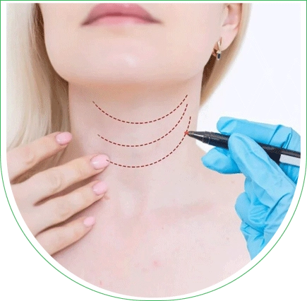 Liposuccion du double menton