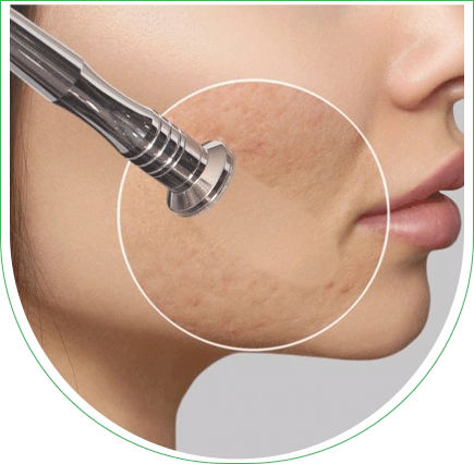 Microdermabrasion en Tunisie